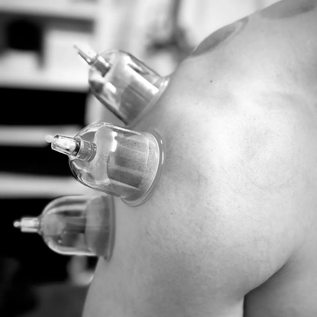 cupping the body expert