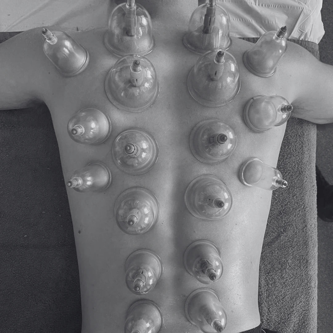 cupping the body expert