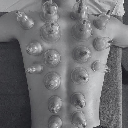 cupping the body expert