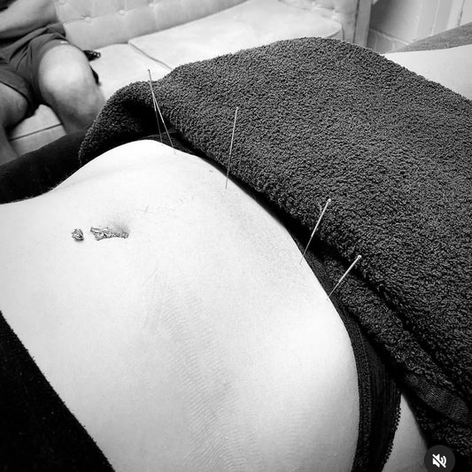 fertility acupuncture